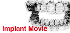 Implant movie